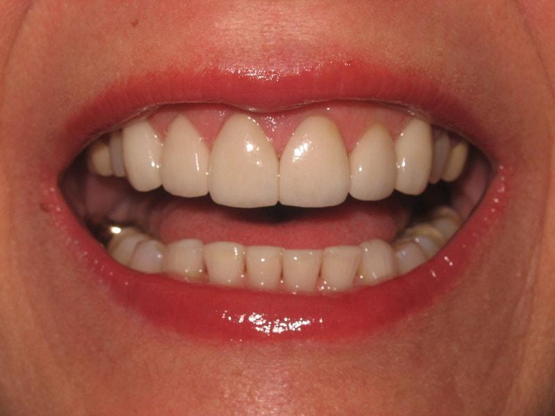 Pomerado Cosmetic Dentistry veneers after — Poway, CA
