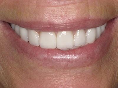 Pomerado Cosmetic Dentistry veneers after — Poway, CA