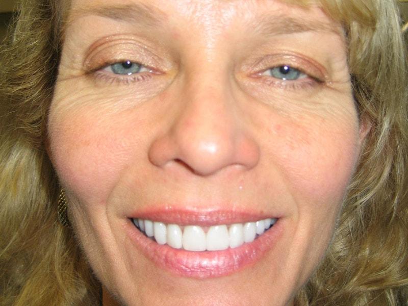 Pomerado Cosmetic Dentistry veneers after — Poway, CA