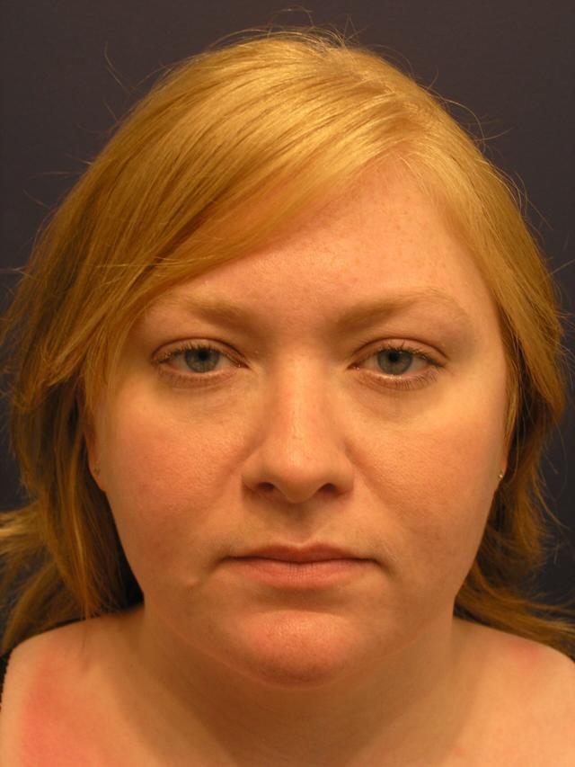 Neck Liposuction after at Dr. Adam Basner Plastic Surgery in Timonium, MD