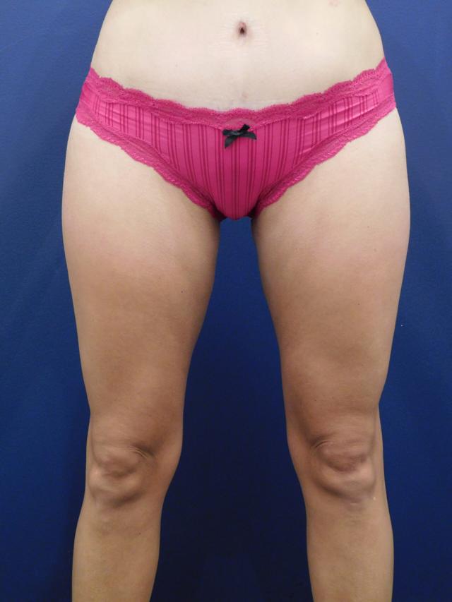 Liposuction after at Dr. Adam Basner Plastic Surgery in Timonium, MD