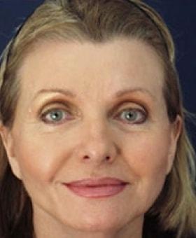 Blepharoplasty after at Dr. Adam Basner Plastic Surgery in Timonium, MD