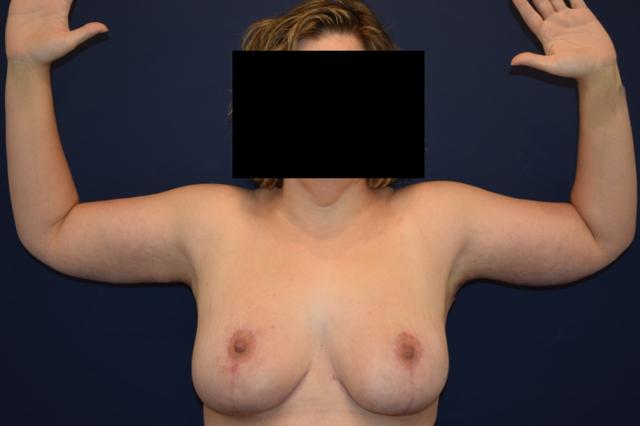 Arm Lift after at Dr. Adam Basner Plastic Surgery in Timonium, MD