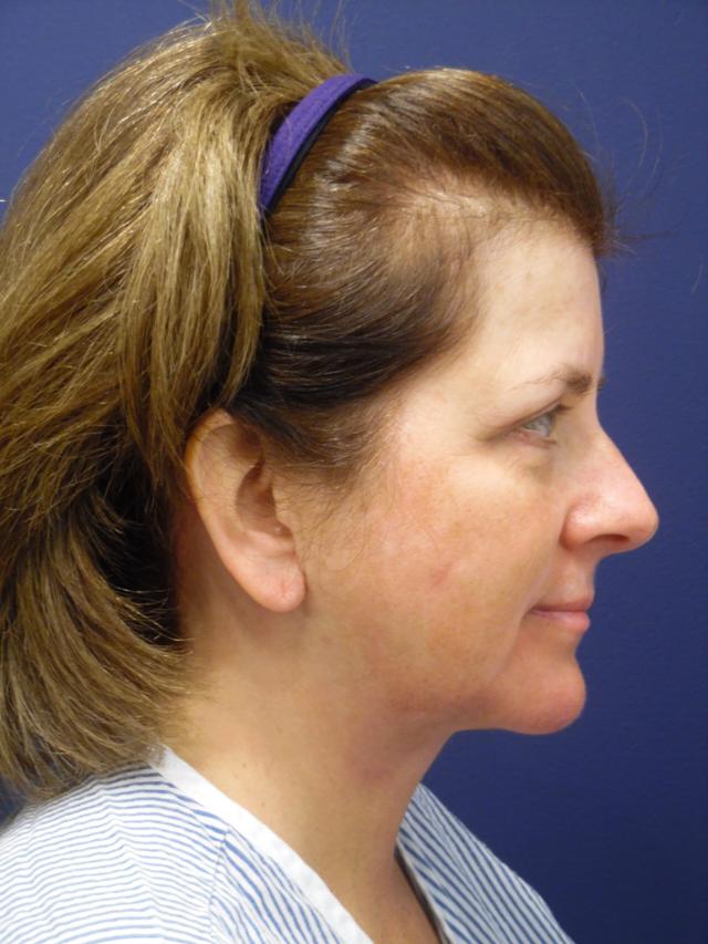Neck Lift after at Dr. Adam Basner Plastic Surgery in Timonium, MD