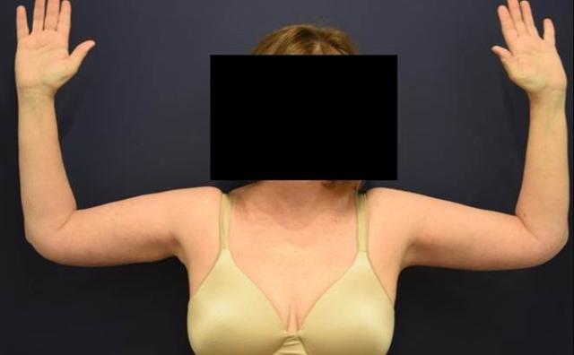 Arm Lift after at Dr. Adam Basner Plastic Surgery in Timonium, MD