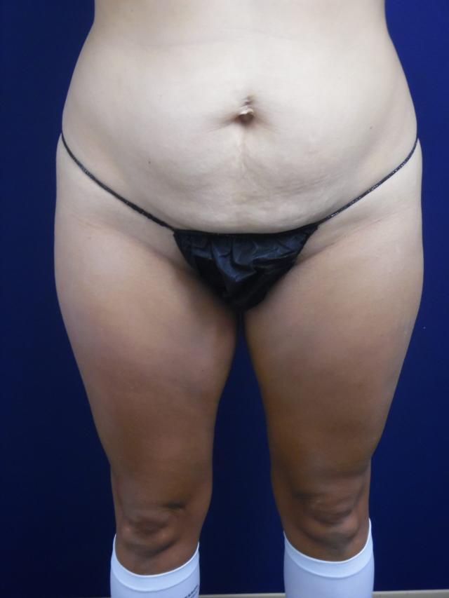 Liposuction before at Dr. Adam Basner Plastic Surgery in Timonium, MD