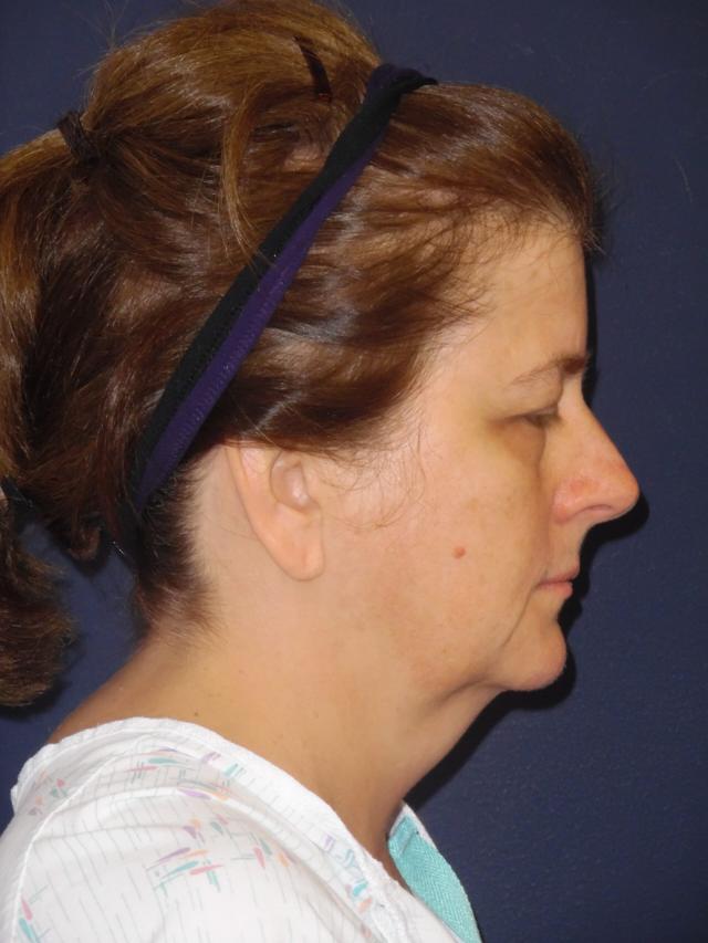 Neck Lift before at Dr. Adam Basner Plastic Surgery in Timonium, MD