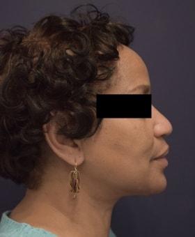 Neck Lift after at Dr. Adam Basner Plastic Surgery in Timonium, MD