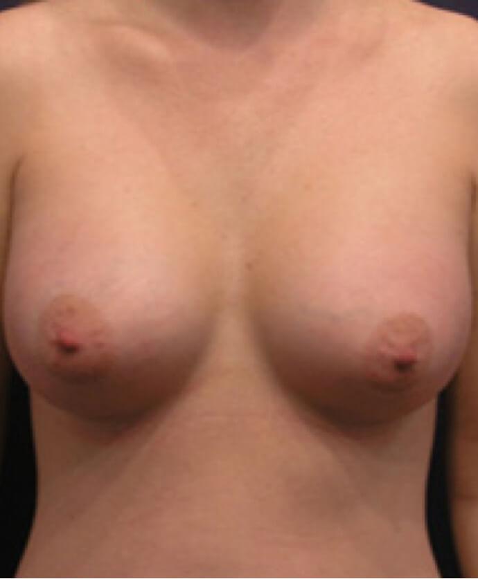 Dr. Adam Basner Plastic Surgery breast augmentation after — Timonium, MD