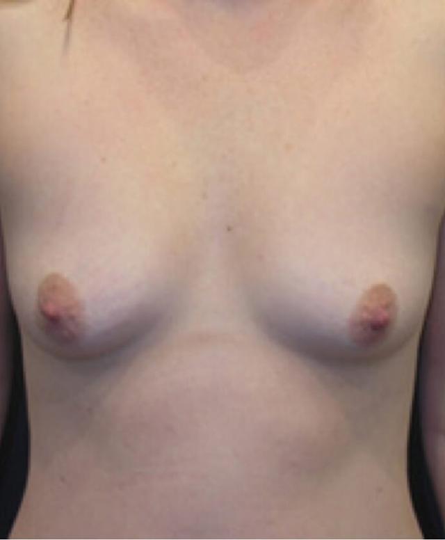 Fat Transfer Breast Augmentation before at Dr. Adam Basner Plastic Surgery in Timonium, MD