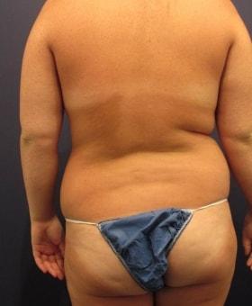 Liposuction before at Dr. Adam Basner Plastic Surgery in Timonium, MD
