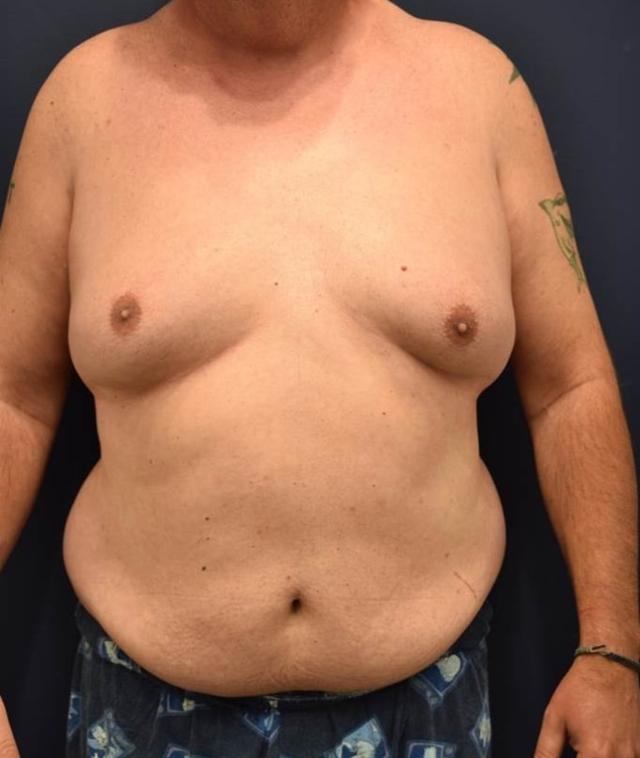Gynecomastia Surgery before at Dr. Adam Basner Plastic Surgery in Timonium, MD