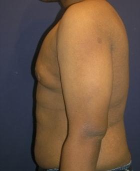 Dr. Adam Basner Plastic Surgery gynecomastia after — Timonium, MD