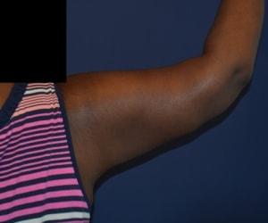 Arm Lift after at Dr. Adam Basner Plastic Surgery in Timonium, MD