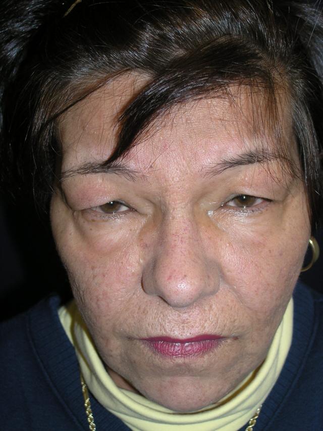 Blepharoplasty before at Dr. Adam Basner Plastic Surgery in Timonium, MD