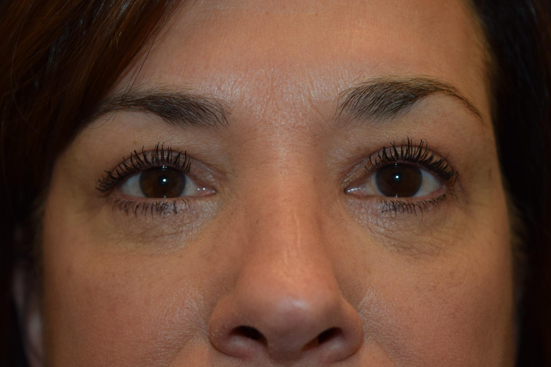 Dr. Adam Basner Plastic Surgery eyelid lift after — Timonium, MD