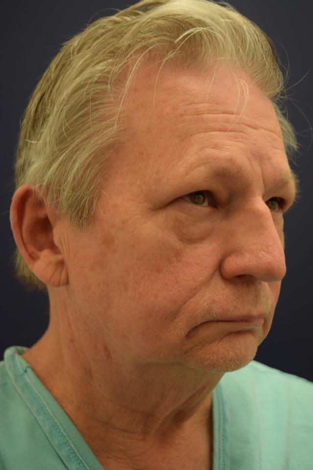 Facelift before at Dr. Adam Basner Plastic Surgery in Timonium, MD