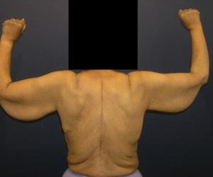 Arm Lift before at Dr. Adam Basner Plastic Surgery in Timonium, MD