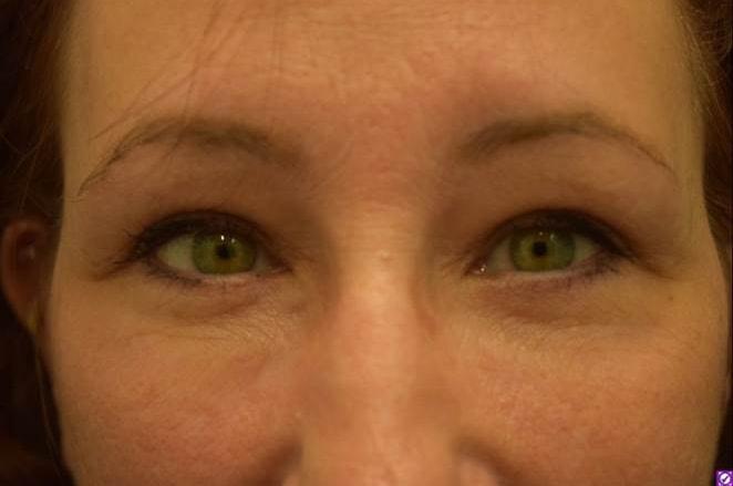 Dr. Adam Basner Plastic Surgery eyelid lift after — Timonium, MD