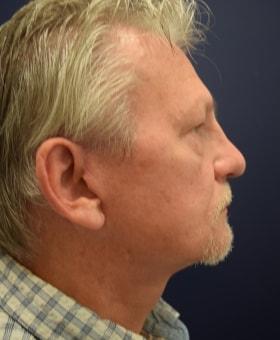 Neck Lift after at Dr. Adam Basner Plastic Surgery in Timonium, MD