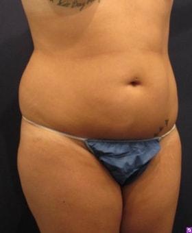 Liposuction before at Dr. Adam Basner Plastic Surgery in Timonium, MD