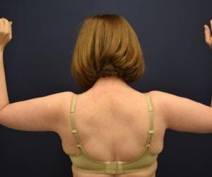 Arm Lift after at Dr. Adam Basner Plastic Surgery in Timonium, MD