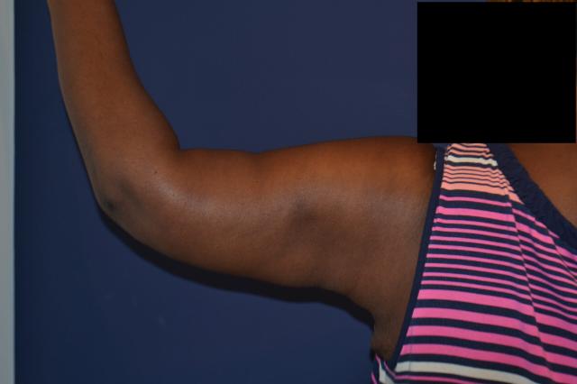 Arm Lift after at Dr. Adam Basner Plastic Surgery in Timonium, MD