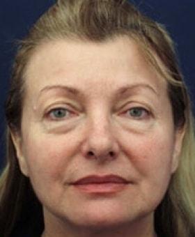 Blepharoplasty before at Dr. Adam Basner Plastic Surgery in Timonium, MD