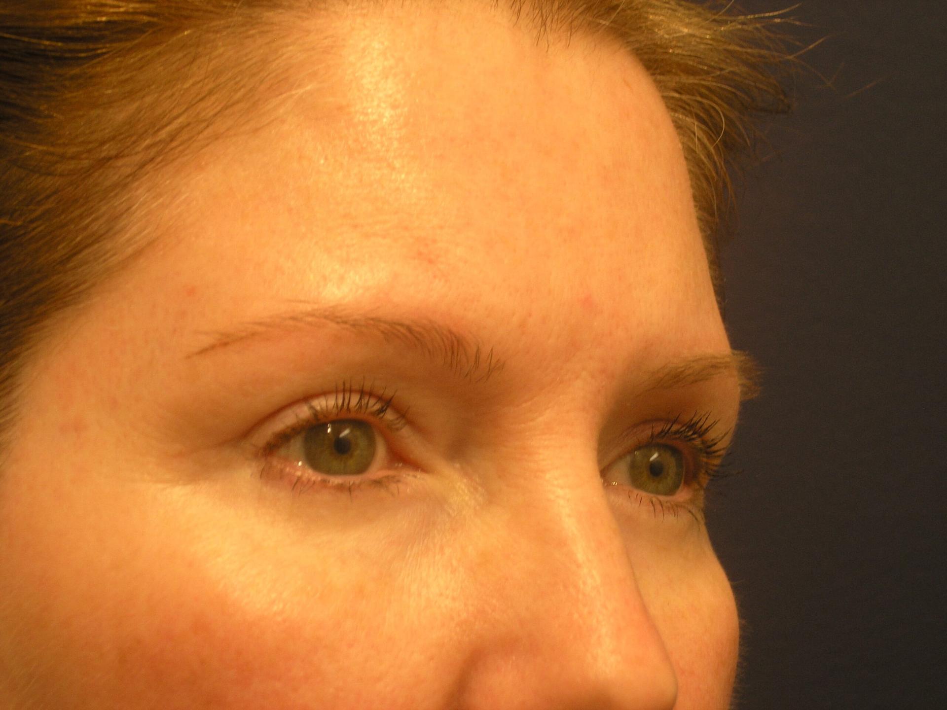 Dr. Adam Basner Plastic Surgery eyelid lift after — Timonium, MD