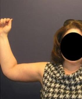 Arm Lift after at Dr. Adam Basner Plastic Surgery in Timonium, MD