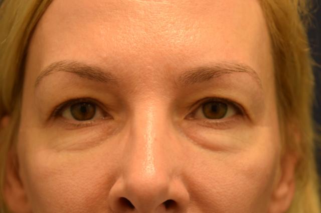 Blepharoplasty before at Dr. Adam Basner Plastic Surgery in Timonium, MD