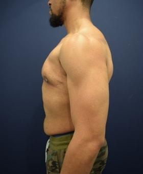 Gynecomastia Surgery after at Dr. Adam Basner Plastic Surgery in Timonium, MD