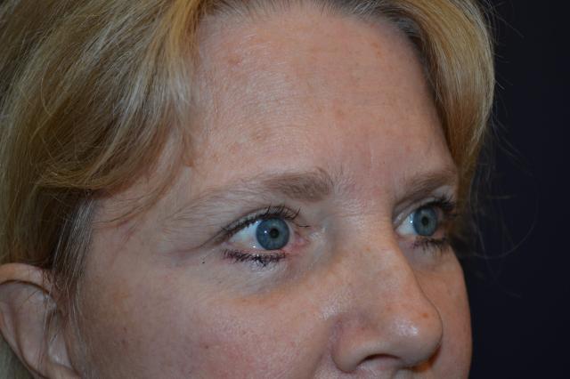 Blepharoplasty after at Dr. Adam Basner Plastic Surgery in Timonium, MD