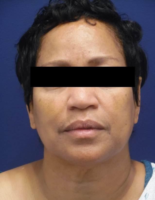 Neck Lift before at Dr. Adam Basner Plastic Surgery in Timonium, MD