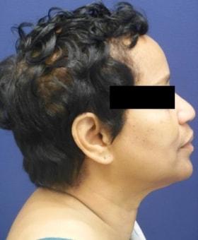 Neck Lift before at Dr. Adam Basner Plastic Surgery in Timonium, MD