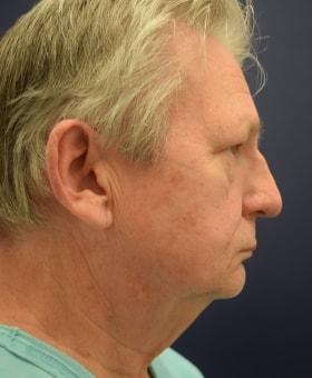 Neck Lift before at Dr. Adam Basner Plastic Surgery in Timonium, MD