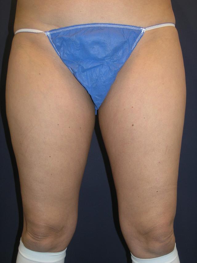 Liposuction before at Dr. Adam Basner Plastic Surgery in Timonium, MD