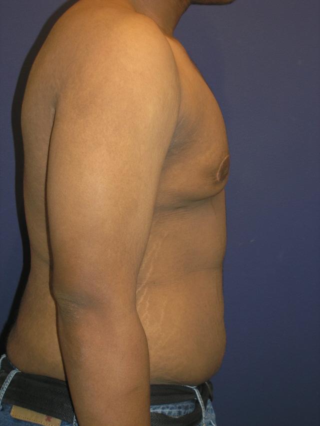 Gynecomastia Surgery after at Dr. Adam Basner Plastic Surgery in Timonium, MD