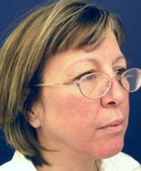 Facelift before at Dr. Adam Basner Plastic Surgery in Timonium, MD