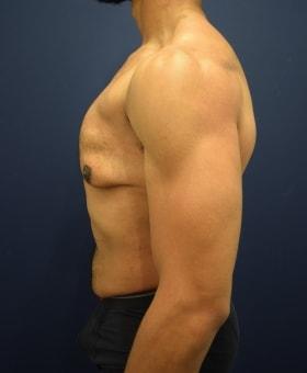 Gynecomastia Surgery before at Dr. Adam Basner Plastic Surgery in Timonium, MD