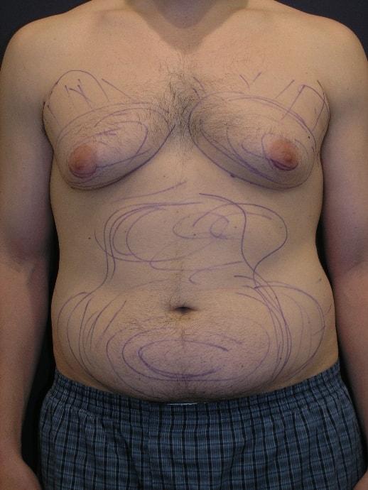 Liposuction before at Dr. Adam Basner Plastic Surgery in Timonium, MD