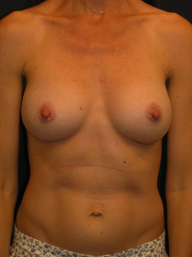 Breast Augmentation after at Dr. Adam Basner Plastic Surgery in Timonium, MD