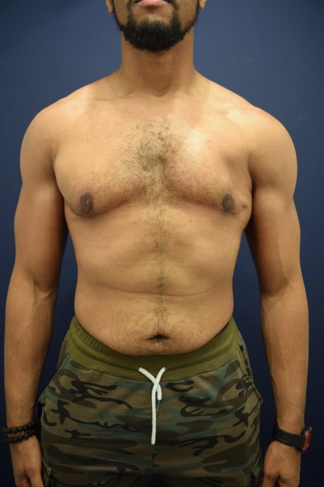 Gynecomastia Surgery after at Dr. Adam Basner Plastic Surgery in Timonium, MD