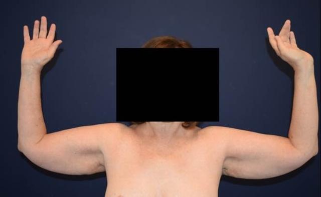 Arm Lift before at Dr. Adam Basner Plastic Surgery in Timonium, MD