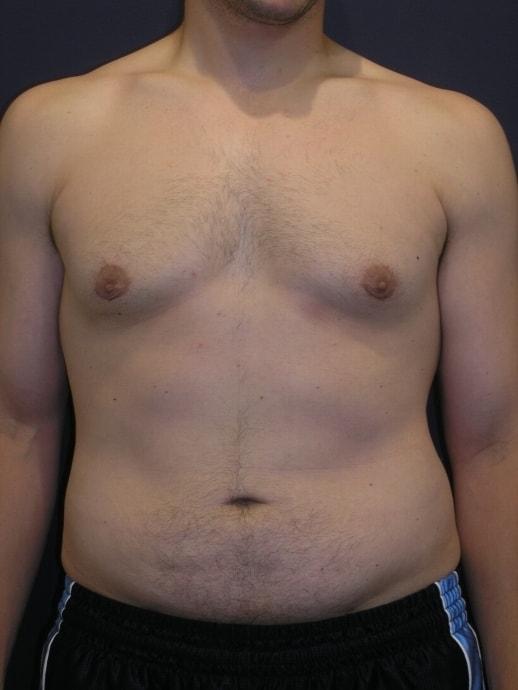 Liposuction after at Dr. Adam Basner Plastic Surgery in Timonium, MD