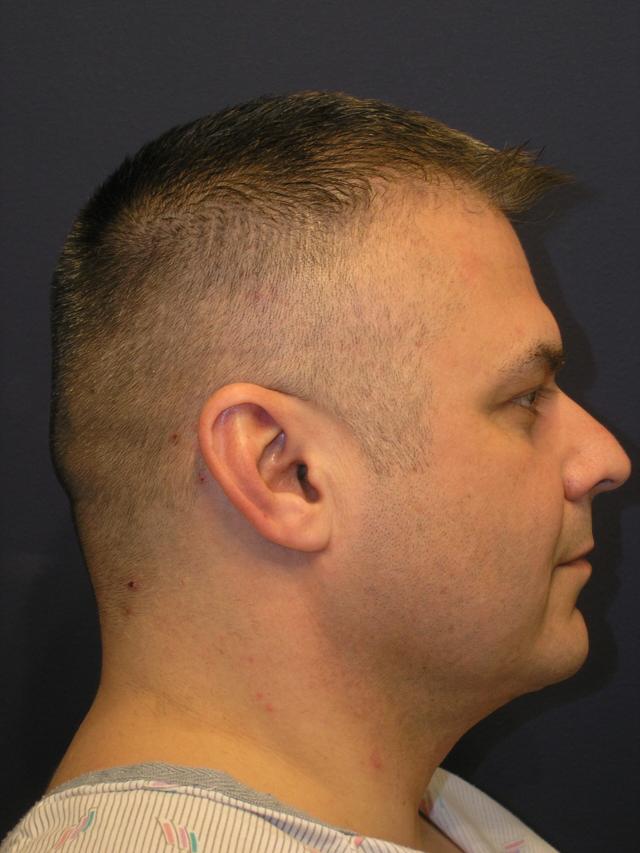 Neck Liposuction after at Dr. Adam Basner Plastic Surgery in Timonium, MD