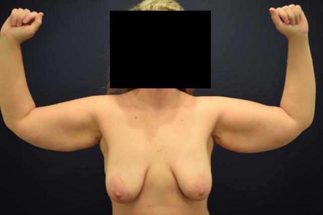 Thigh Lift before at Dr. Adam Basner Plastic Surgery in Timonium, MD