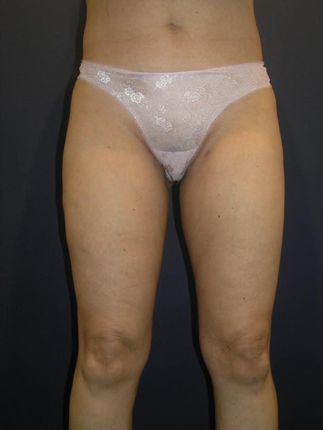 Liposuction after at Dr. Adam Basner Plastic Surgery in Timonium, MD