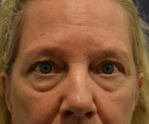 Blepharoplasty before at Dr. Adam Basner Plastic Surgery in Timonium, MD