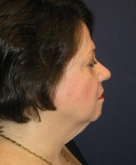 Neck Lift before at Dr. Adam Basner Plastic Surgery in Timonium, MD